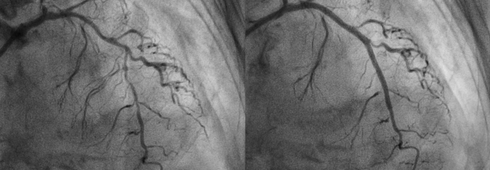 Nach der Implantation eines modernen medikamentenfreisetzenden Stents (hier im vorderen, absteigenden Ast der linken Koronararterie) kann die Dauer der dualen Plättchenhemmung deutlich verkürzt werden.