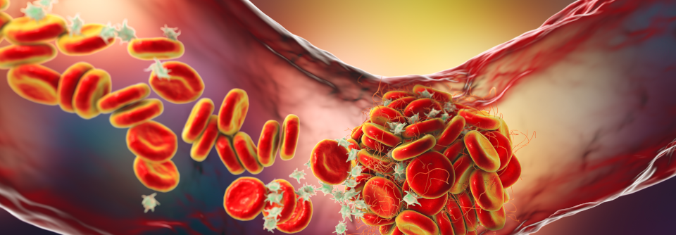 Krebspatienten mit hohem Thromboembolierisiko können erheblich von einer primären Thromboseprophylaxe profitieren.