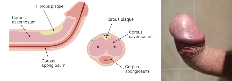 Bei der Peyronie-Krankheit bildet sich im Penis Narbengewebe, das ihn bei einer Erektion verformt (meist nach oben).
