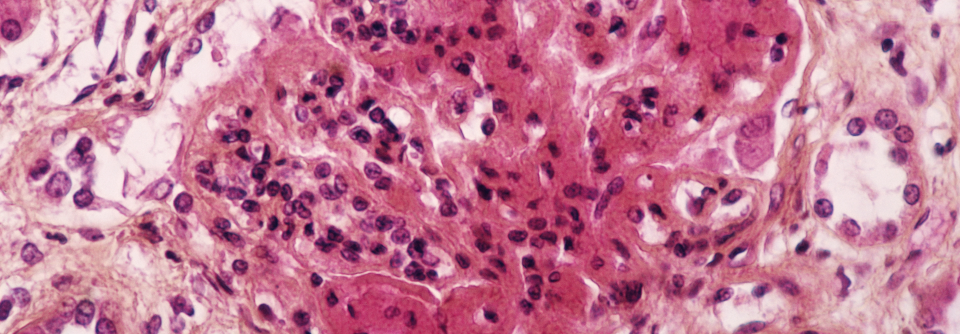 Eine Glomerulonephritis betrifft etwa die Hälfte der Lupuspatienten. Histologisch lassen sich die Immunkomplex-Ablagerungen erkennen. 