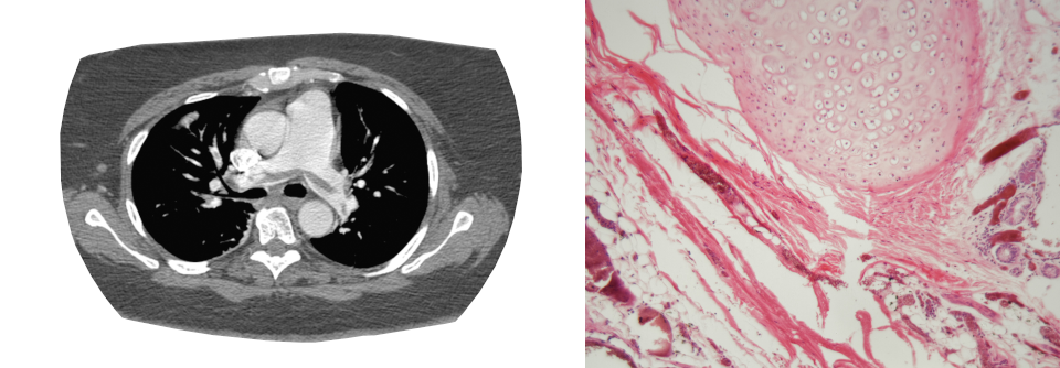 Steckt im Truncus pulmonalis ein Gerinnsel fest, sind die Überlebensaussichten schlecht.