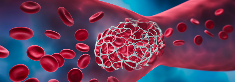 Von Blutungsneigung bis Thrombosen: Gerinnungsstörungen gekonnt aufspüren Thrombophilien werden hämatologische Veränderungen genannt, die eine Gerinnungsneigung auslösen.