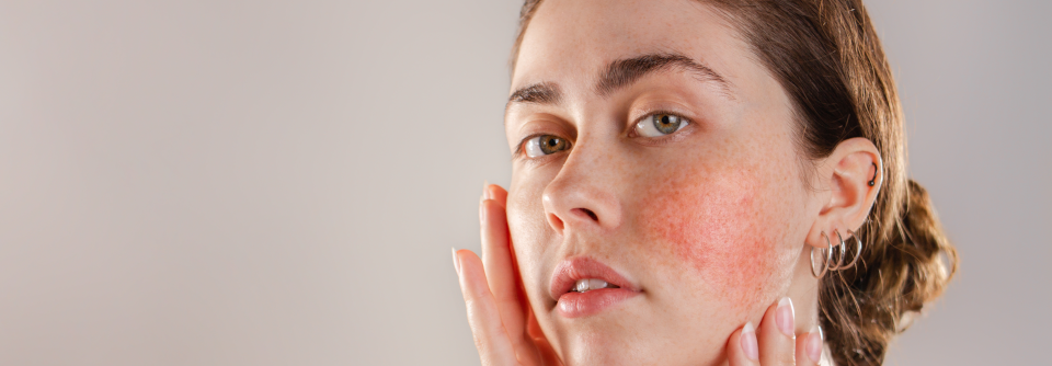 Schwangere mit Rosacea fulminans sicher behandelbar Insgesamt eigne sich Azithromycin für die schnelle Kontrolle der Entzündung. (Agenturfoto)