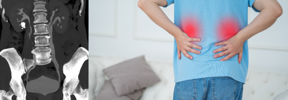 Die früher übliche extrakorporale Stoßwellentherapie kommt inzwischen auch aufgrund der technisch immer weiter entwickelten endoskopischen Verfahren seltener zum Einsatz.