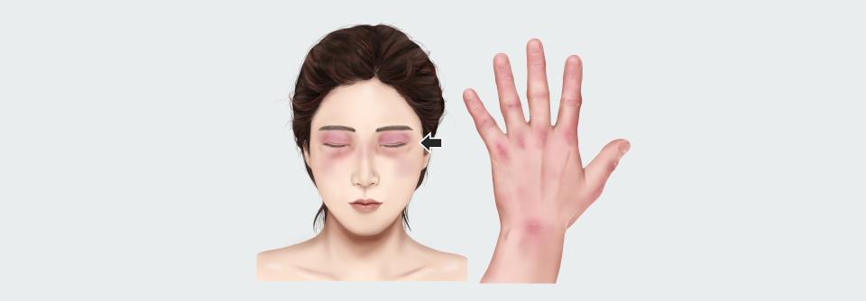 Expression von Proteinkinase R bei Dermatomyositis erhöht In einer Auswertung mit Myoblasten und Myotuben zeigte sich in vitro, dass Interferon beta die Expression von PKR und weiteren dermatomyositisassoziierten muskelschädigenden Molekülen verstärkt.