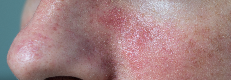 In der Psoriasistherapie vor Infektionen geschützt Aufgrund des günstigen Nutzen-Risiko-Verhältnisses könnten die IL-Inhibitoren für ältere Patientinnen und Patienten mit Psoriasis vorteilhaft sein dazu beitragen, schwere Infektionen zu verhindern.