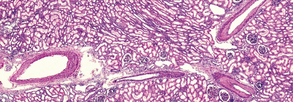 Glomeruli mit Vernarbungen der Blutgefäße sind ein charakteristisches Bild bei FSGS.