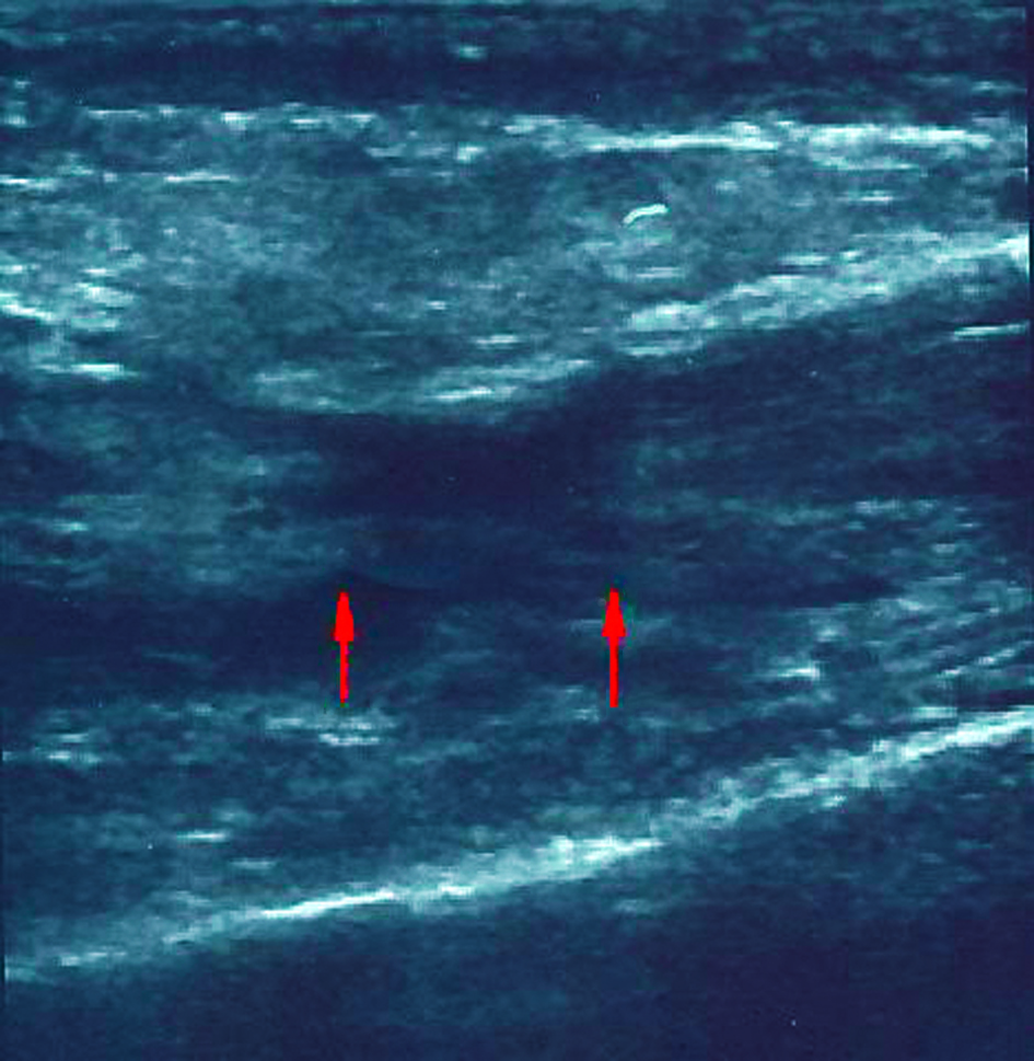 In der Sonographie lässt sich die Ruptur der Sehne anhand der Dehiszenz der Stümpfe gut erkennen.