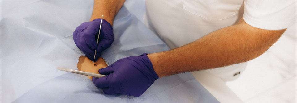 Eine weite Lokalexzision beim In-situ-Melanom könnte bei tumorfreien Rändern verzichtbar sein.