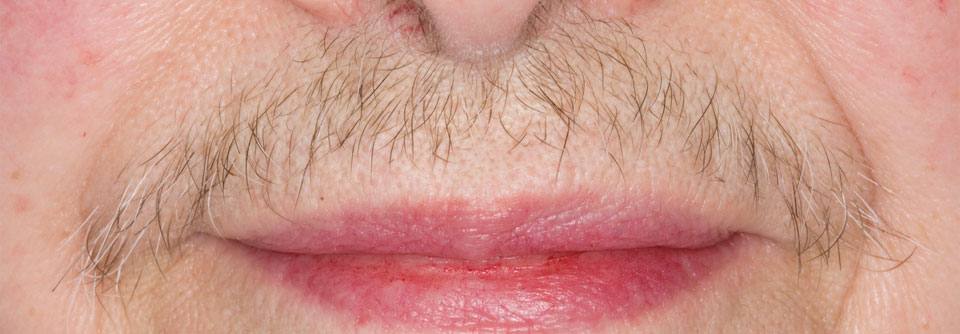 Hirsutismus kann bei Frauen infolge eines polyzystischen Ovarsyndroms auftreten.