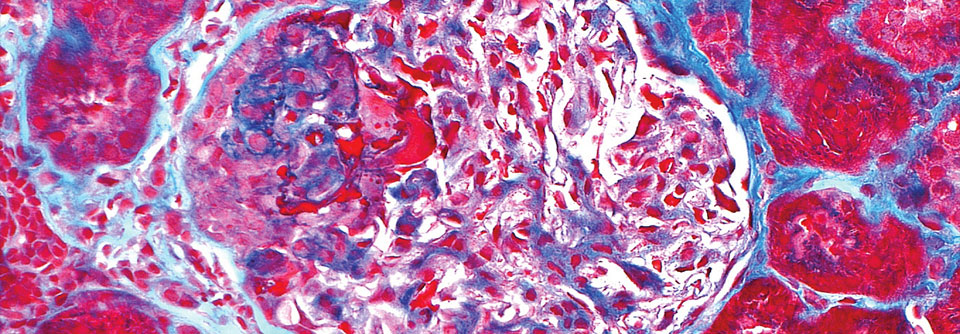 Glomerulonephritis bei ANCA-Vaskulitis im histologischen Schnitt. Zu sehen
ist ein Glomerulus mit typischer halbmondförmiger Schädigung (oben links).